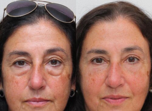 Eye Therapy photo review