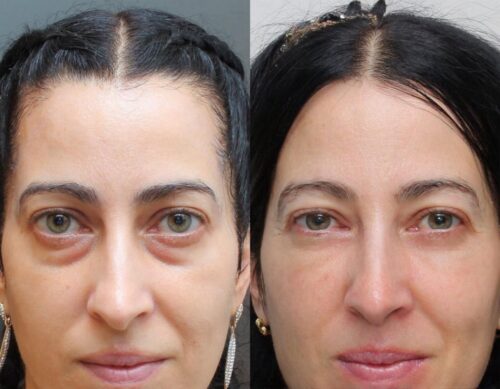 Eye Therapy photo review