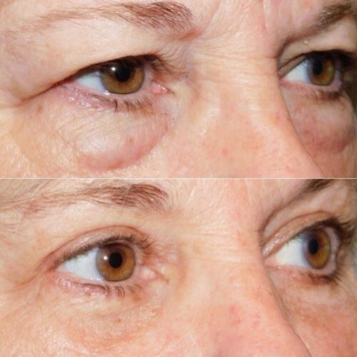 Eye Therapy System photo review