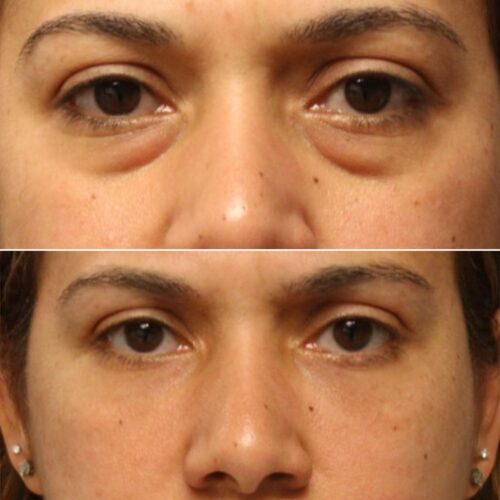 Eye Therapy photo review