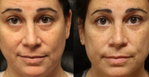 Eye Therapy photo review