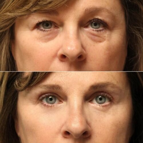 Eye Therapy photo review