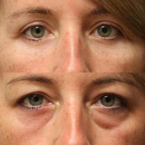 Eye Therapy photo review